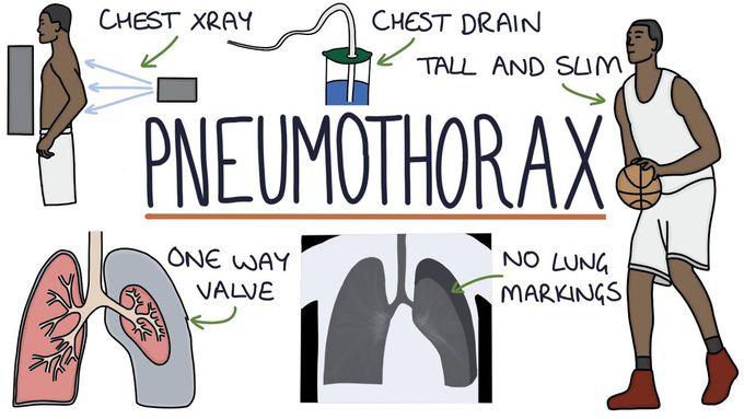 Introduction to Pneumothorax