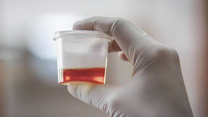 Hematuria