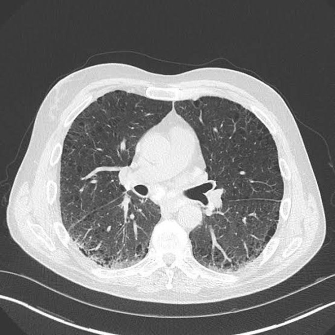 Treatment of caplan syndrome