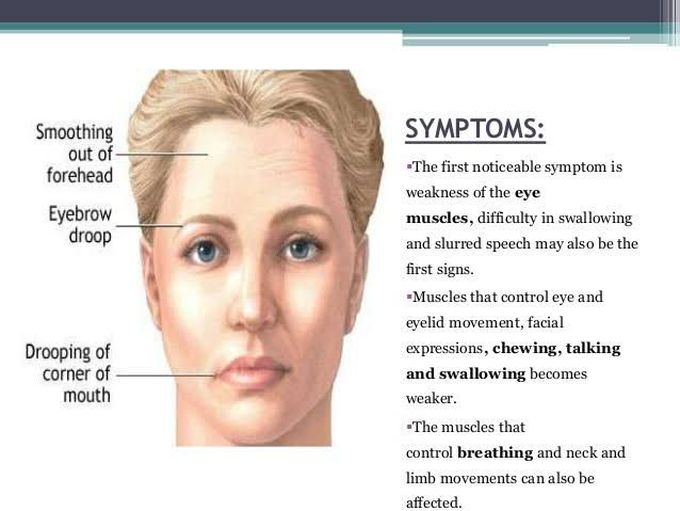 Symptoms of myastheni gravis