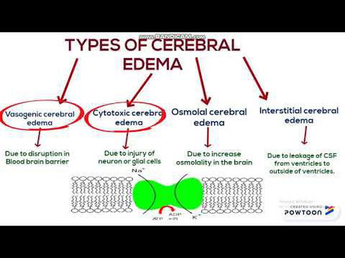 Cerebral Edema and Its Types