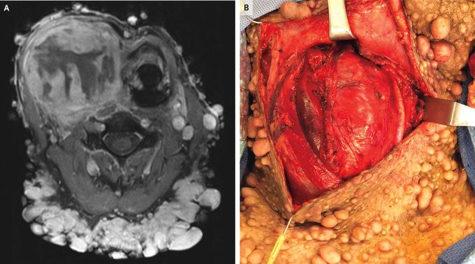 Malignant Peripheral Nerve-Sheath Tumor