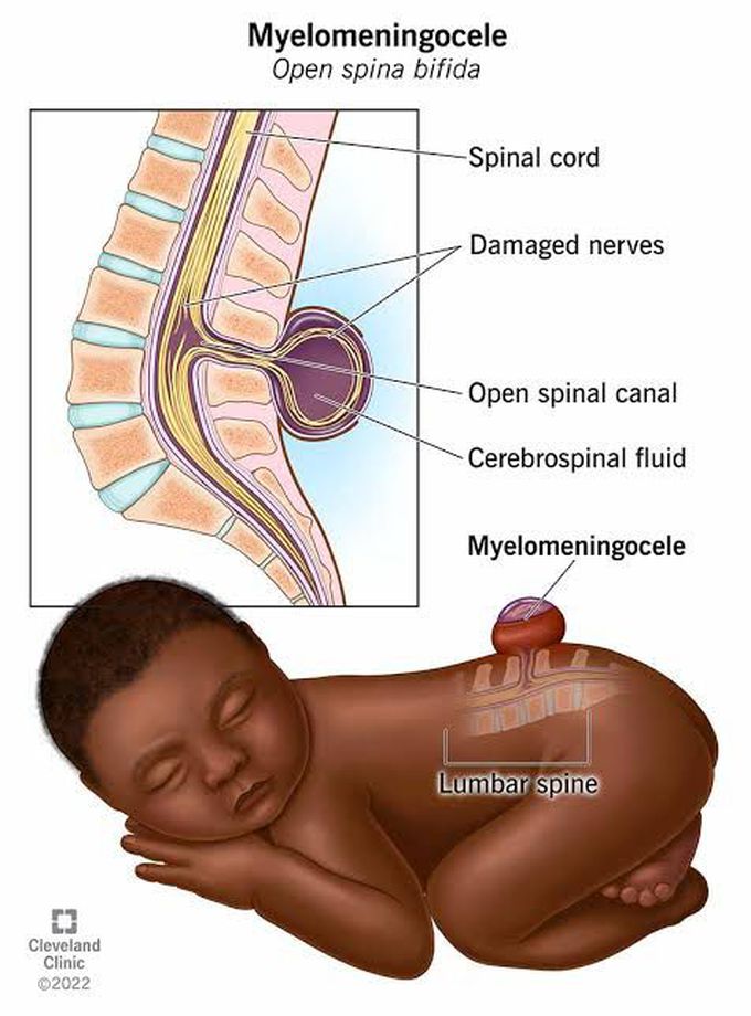 What is myelomeningocele?