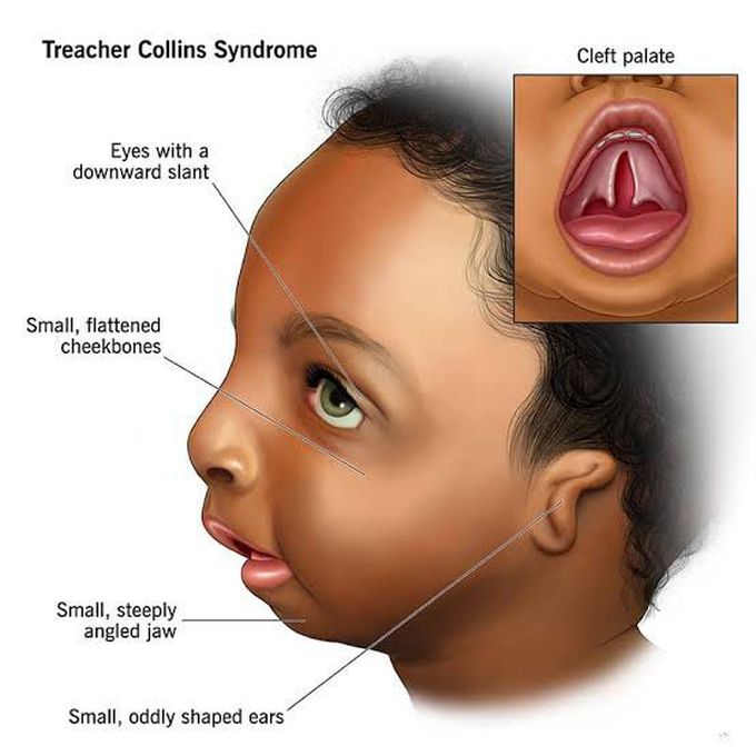 These are the symptoms Treacher Collins syndrome