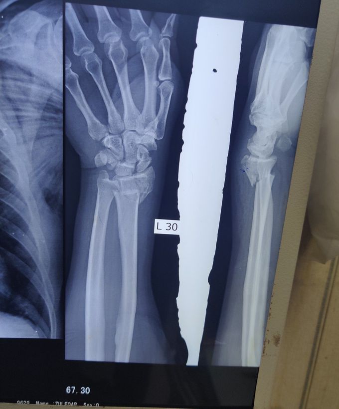 Distal Radius Fracture