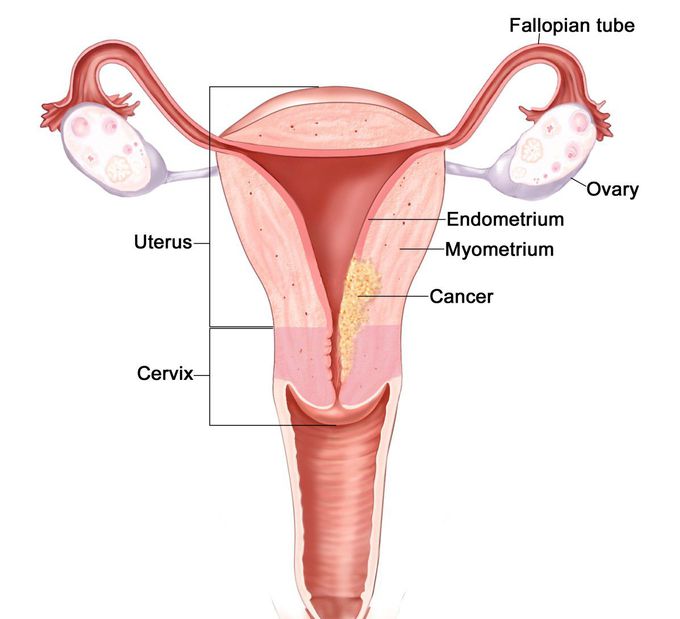 Uterine cancer