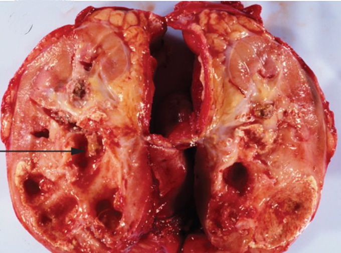 Urinary tract infection
