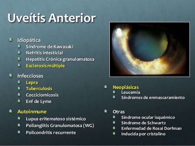 Uveitis anterior