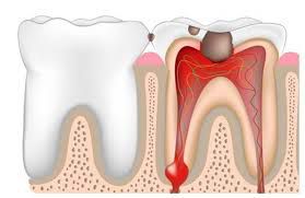 Cause of pulpitis - MEDizzy