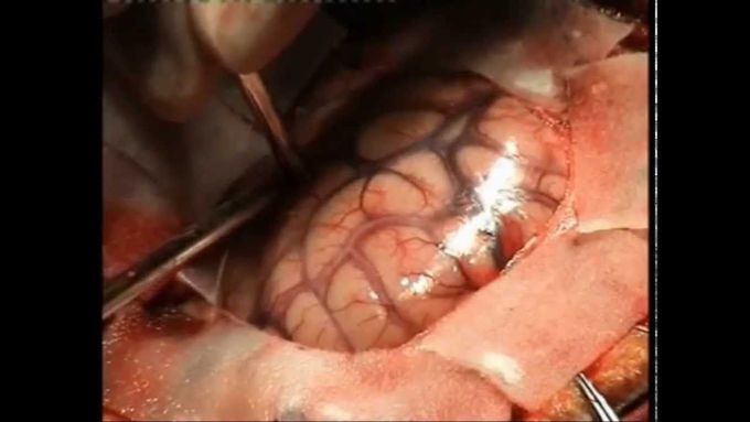 Brain Tumor Surgery - Brain Tumor Surgery Risks