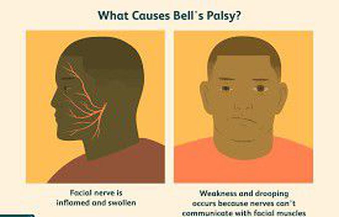 Causes of bell's palsy