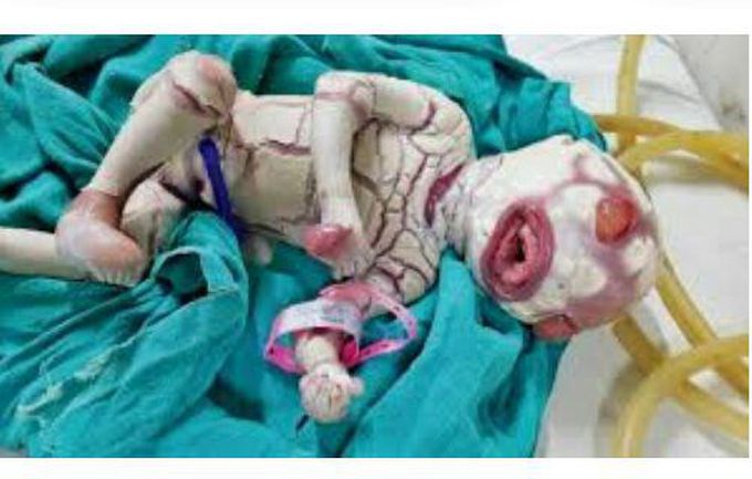 Harlequin Ichthyosis syndrome
