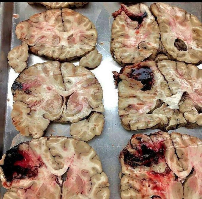 Blood clot