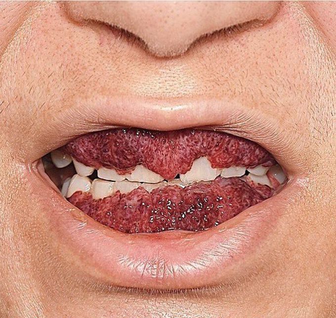 Strawberry gingivitis