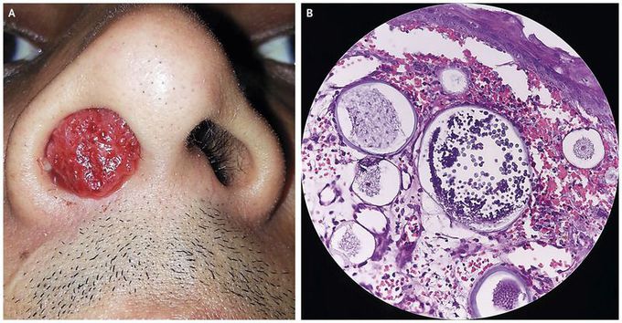 Rhinosporidiosis