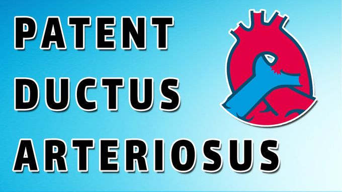 Patent Ductus Arteriosus - A review