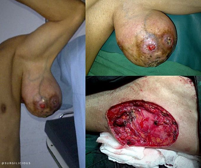 Lipoma