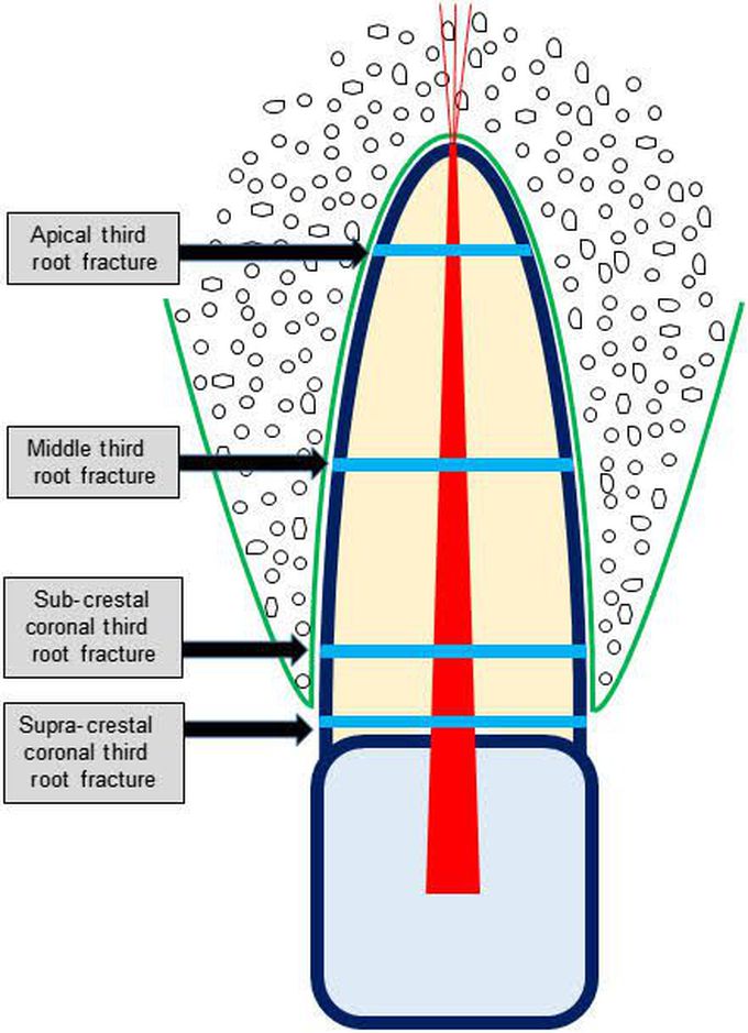 Root fracture