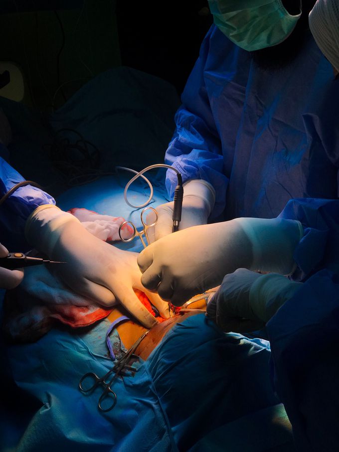 I thyroidectomy
