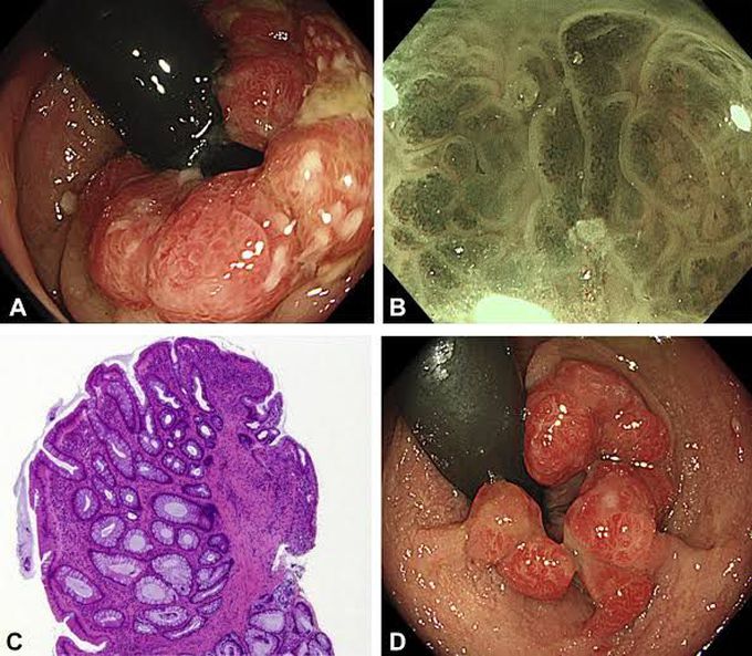 Mucosal prolapse