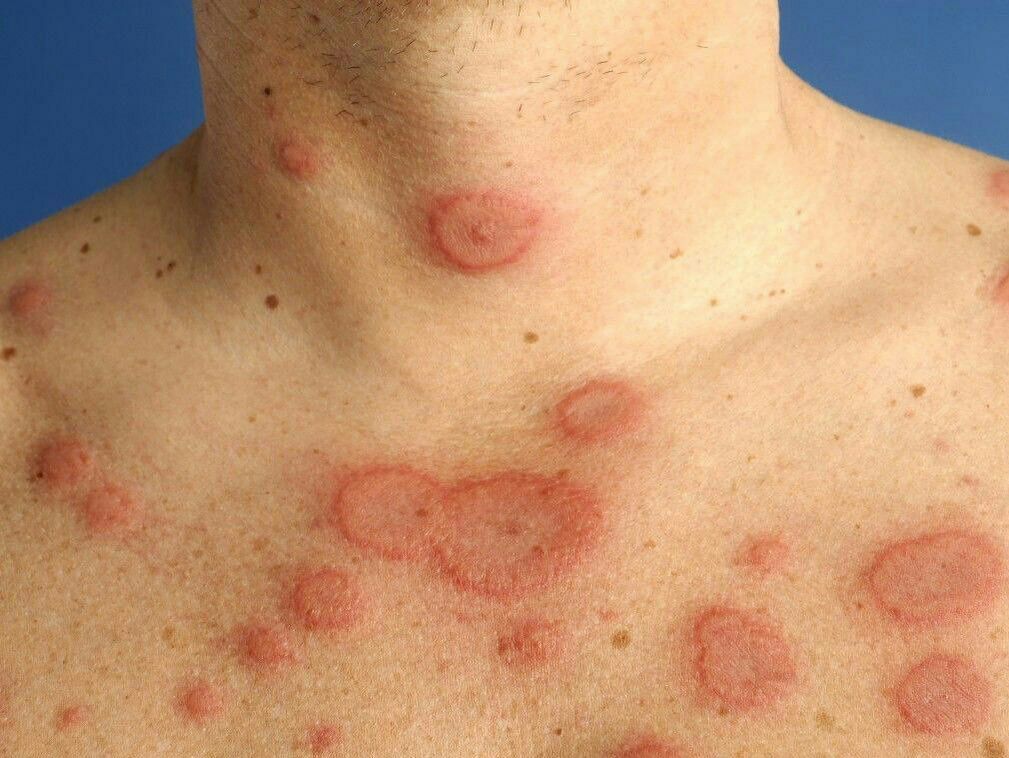 Erythema multiforme - MEDizzy