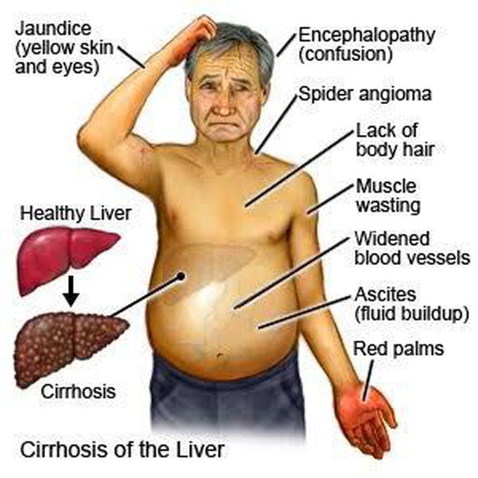 Cirrhosis of liver