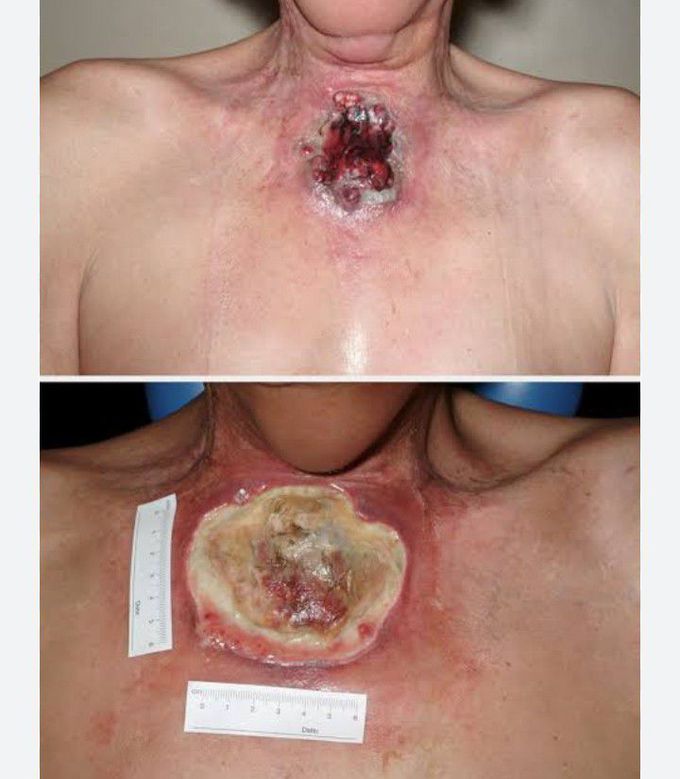 Treatment for Necrotic lesions