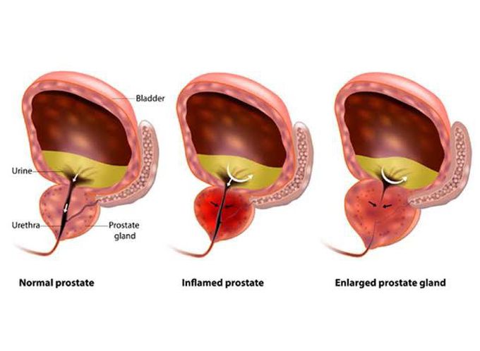 Benign Prostatic Hyperplasia