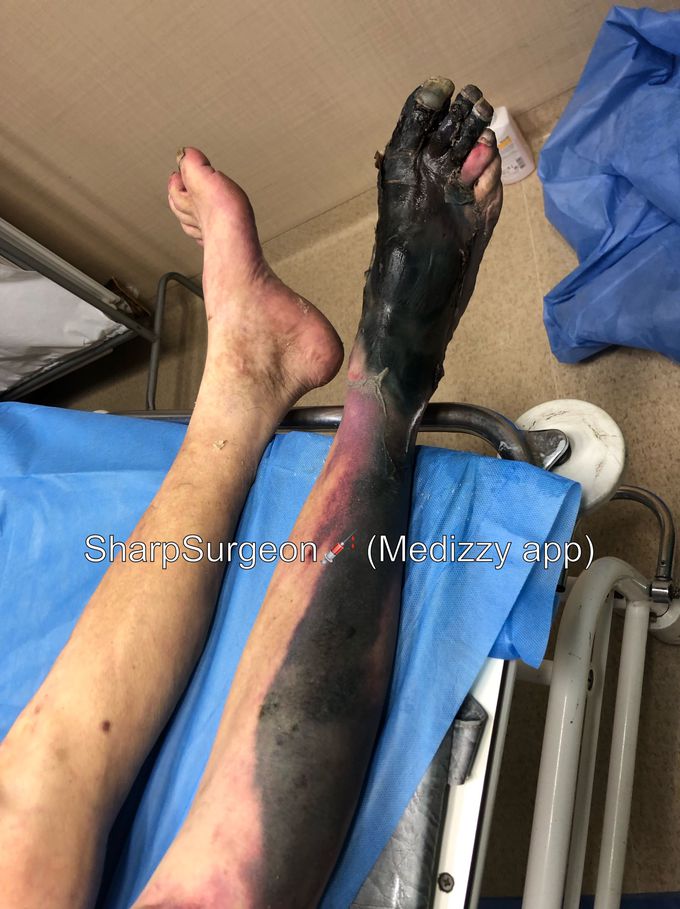 Another hardcore case -> Leg necrosis! 🤯💀