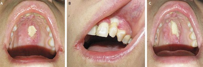 Destructive Ulcerated Lesions of the Hard Palate
