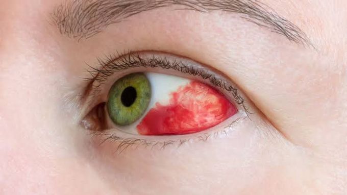 Subconjunctival hemorrhage