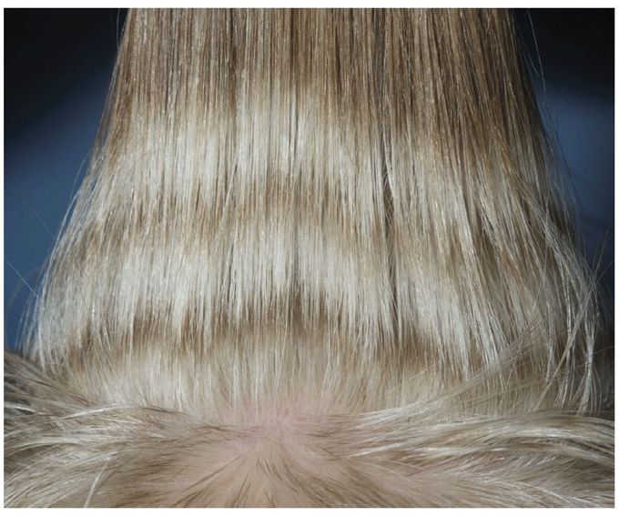 Sunitinib-Associated Hair Depigmentation