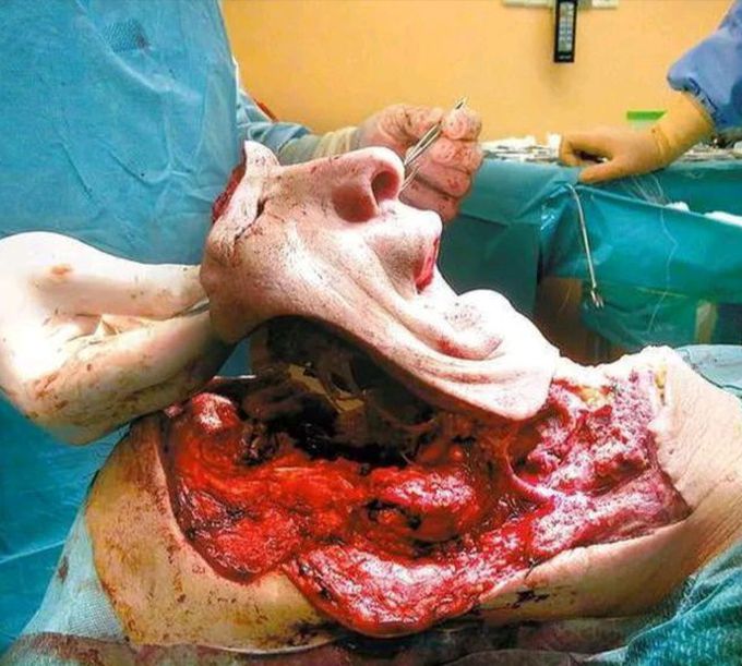 Face transplant