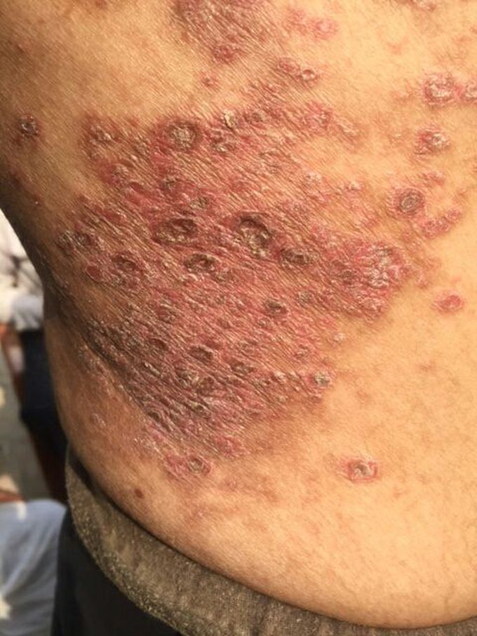Crack the case:

A 38 yr M pt complaint of itching <night,<warmth<perspiration
>covering, with burning and watery discharge.. What is the diagnosis??