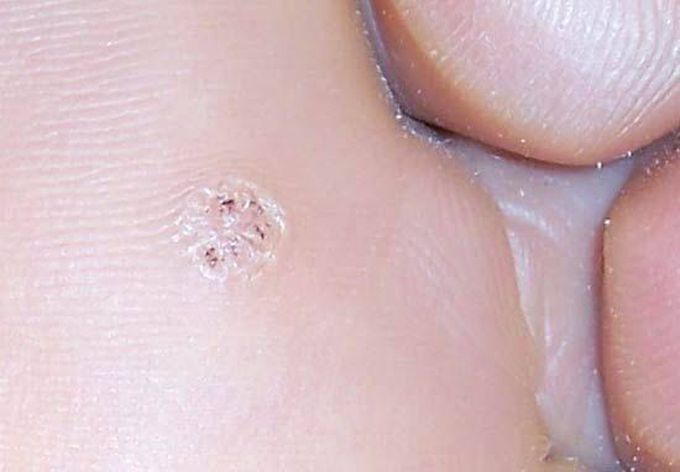 Causes of warts
