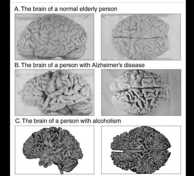 How Alzheimer and alcohol effects the brain