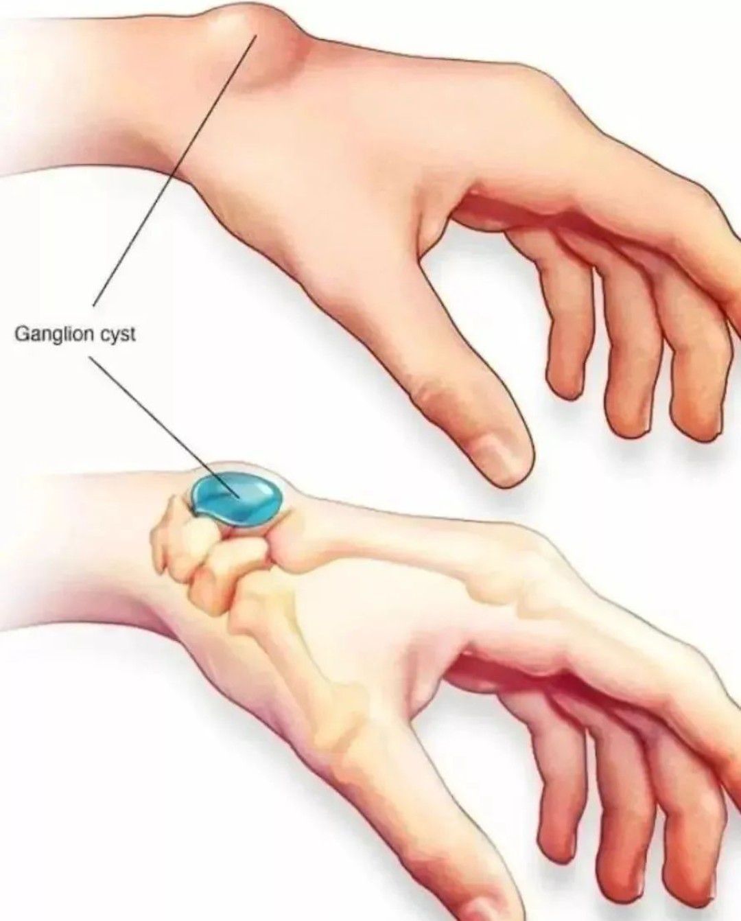 Почему болят руки с внутренней стороны. Гигрома лучезапястного. Ганглий лучезапястного сустава. Гигрома лучезапячст ного сустава. Гигрома лучезапястного сустава.