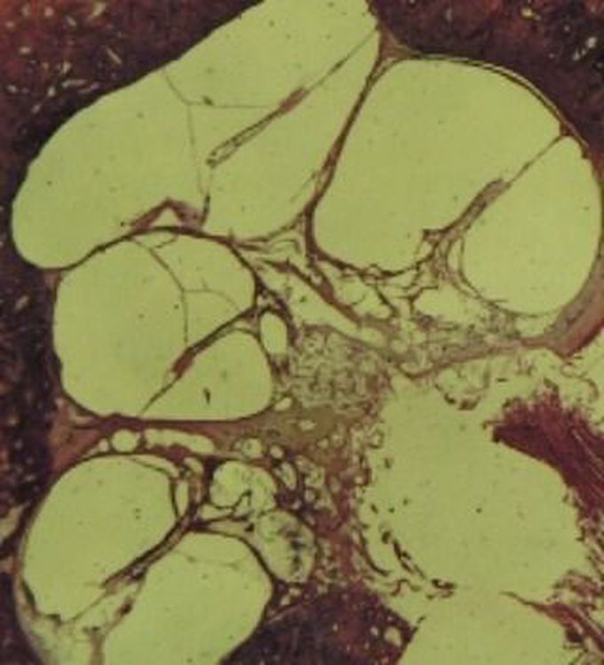 Meniere's Disease