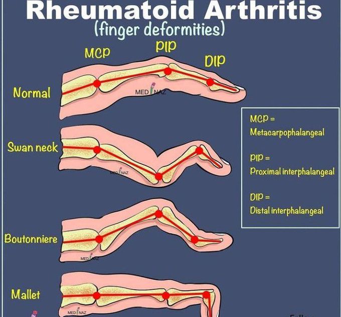 Finger deformities in rheumatoid arthritis