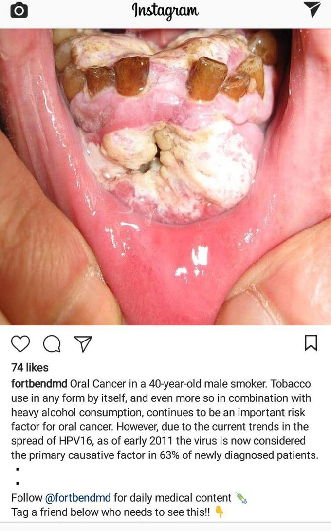 mouth cancer from alcohol