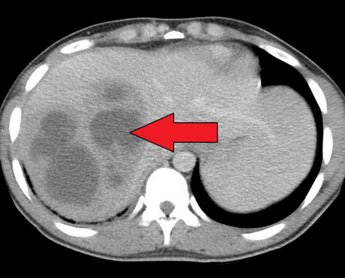 Pyogenic Liver Abscess