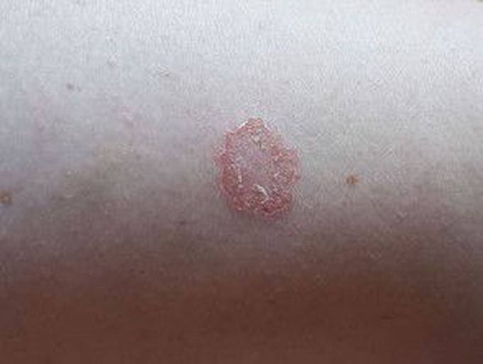 Discoid eczema