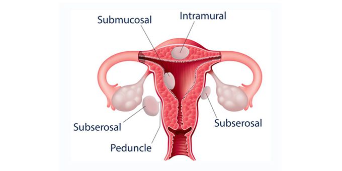 Types of Uterine Fibroids