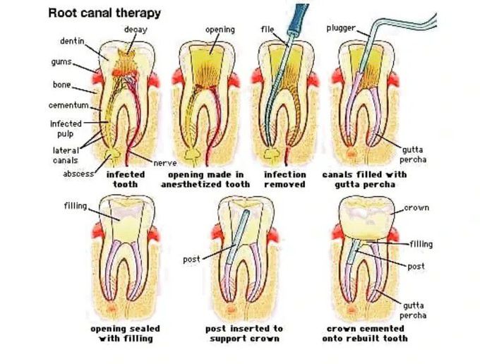 Root canal therapy