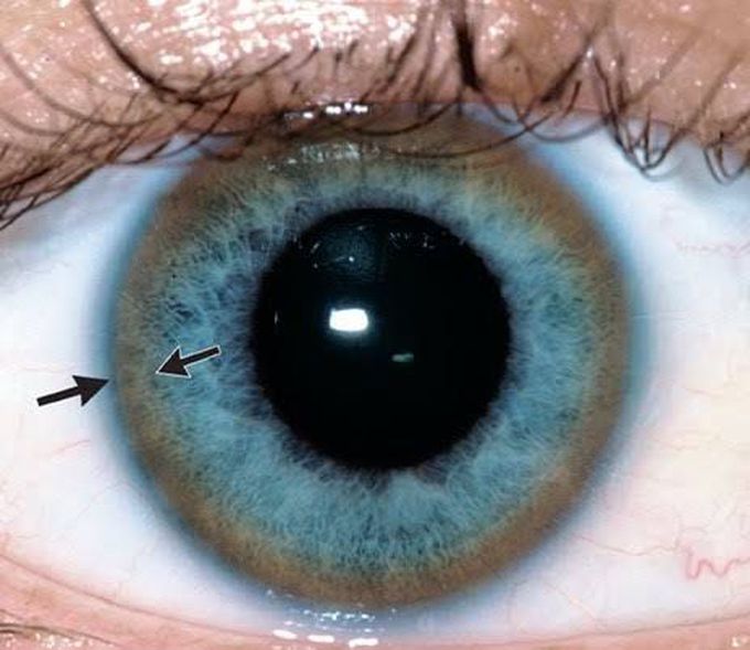 Kayser-Fleischer ring at the rim of cornea in a patient with Wilson disease