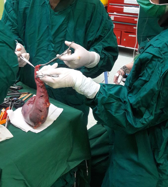#Sleeve Gasterectomy.  Bahonar Hospital in Kerman، Iran
