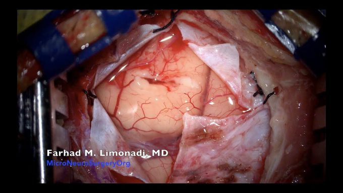 Brain Surgery : Surgical removal of glioblastoma multiforme (GBM)