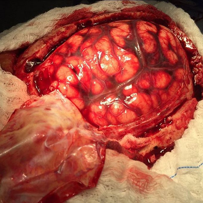 Left decompressive craniectomy