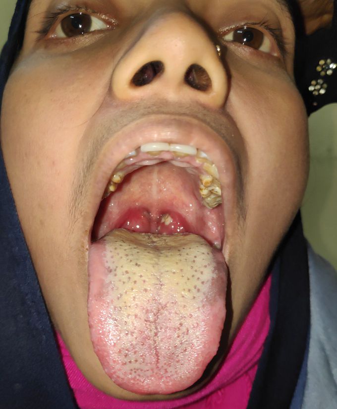 Acute Tonsillitis