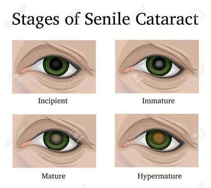 Stages of Senile Cataract